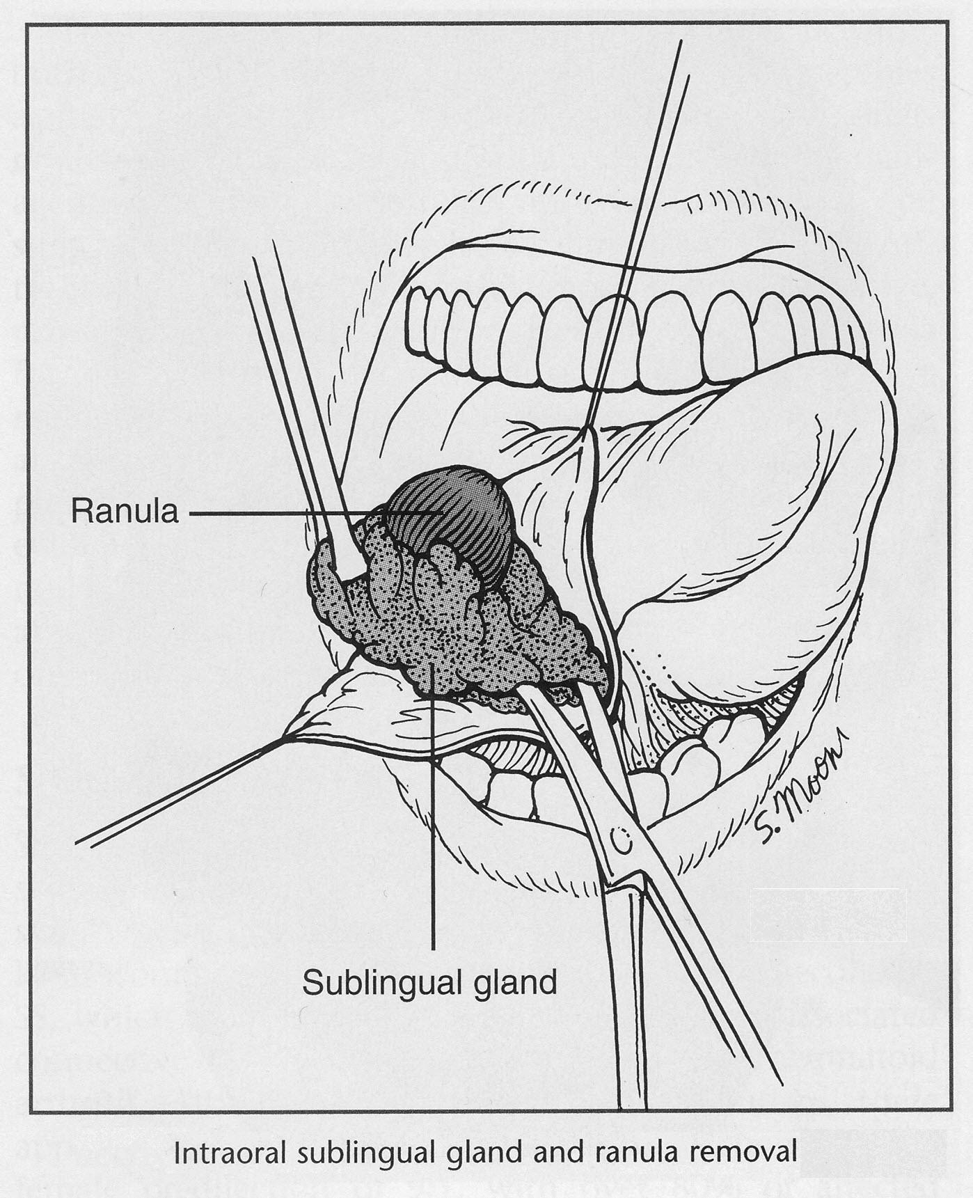 Ranulas / Ranulae & Their Treatment29